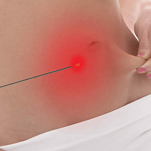 Lipoarpiração a Laser